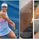 US Open, Stefanini e il livido sul braccio: “Colpa di un controllo antidoping…”