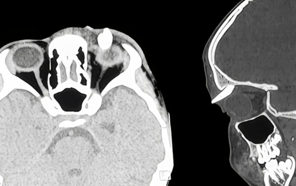 Ha un gonfiore sotto l’occhio, in ospedale scoprono che ha un dente nella palpebra: lo strano caso in India