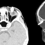 Ha un gonfiore sotto l’occhio, in ospedale scoprono che ha un dente nella palpebra: lo strano caso in India