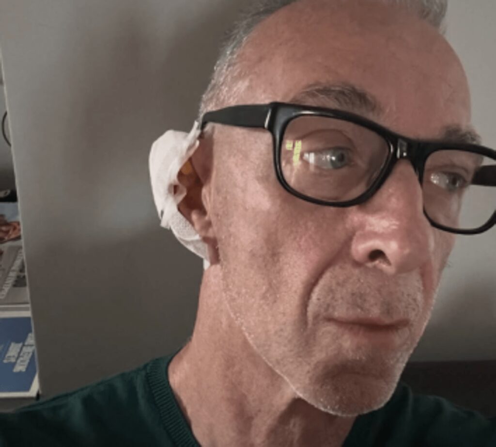 Linus ha una malattia della pelle: “Si chiama Epitelioma”. Di cosa si tratta